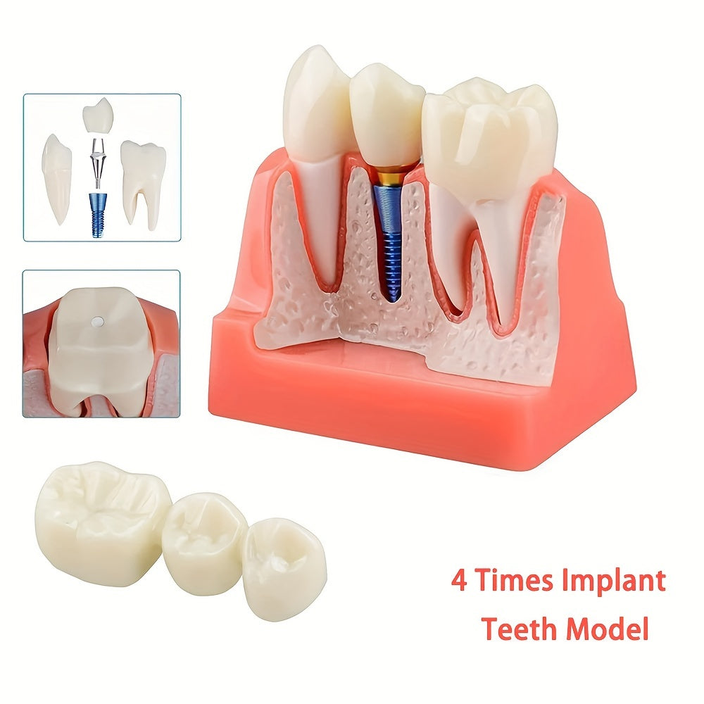 Removable Dental Implant Model with 4 Crown Bridges PVC Material for Education