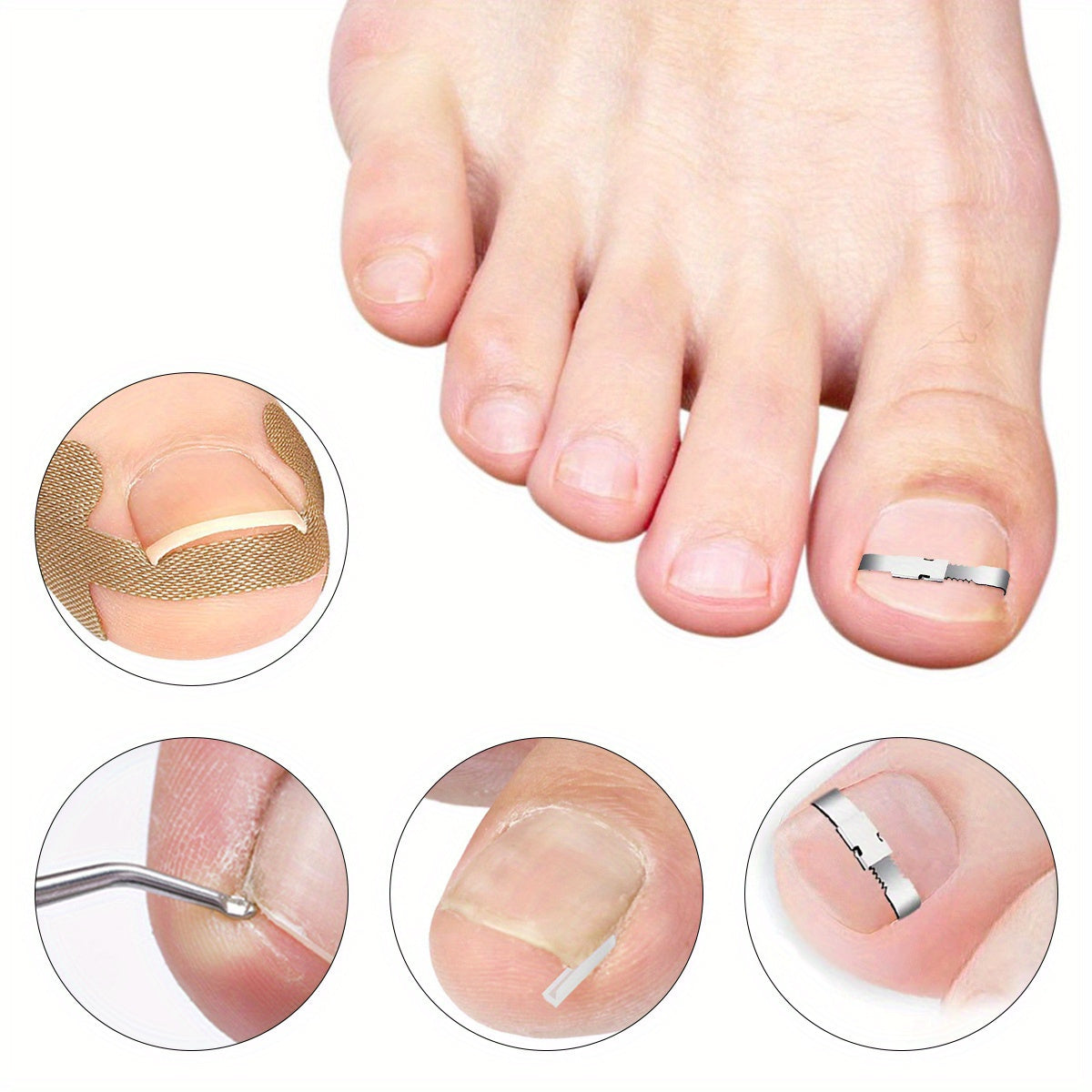 4 dona Ingrown Toenail Care Kit zanglamaydigan po'latdan yasalgan oyoq parvarishi to'plami