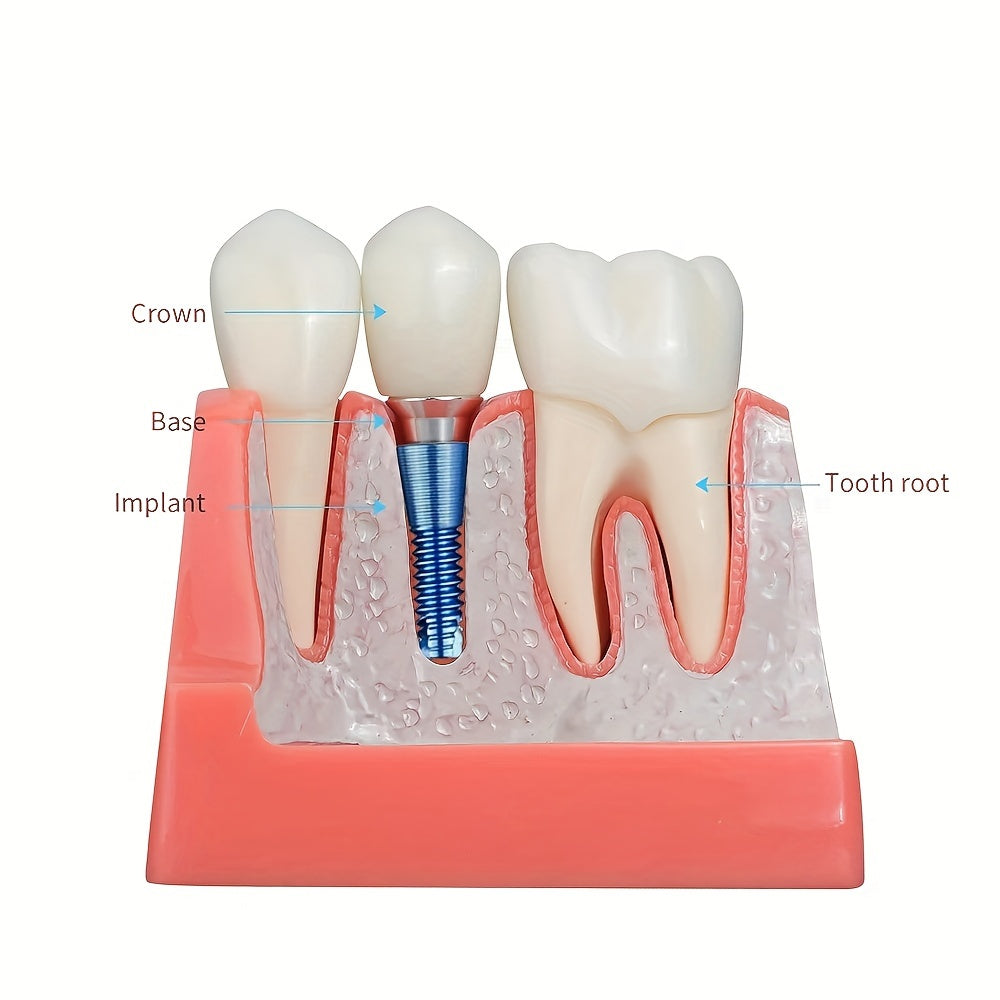 Removable Dental Implant Model with 4 Crown Bridges PVC Material for Education