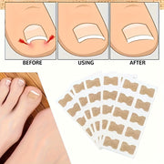 Toe Nail Correctors Packs of 50 100 200 Non-Woven Toenail Patches for Nail Repair