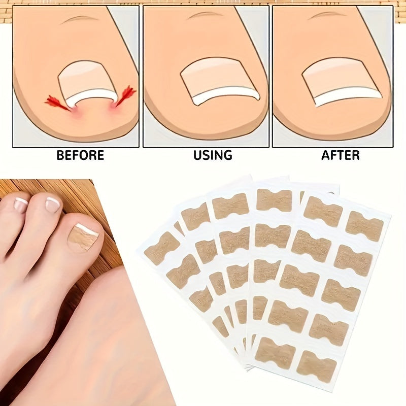 Toe Nail Correctors Packs of 50 100 200 Non-Woven Toenail Patches for Nail Repair