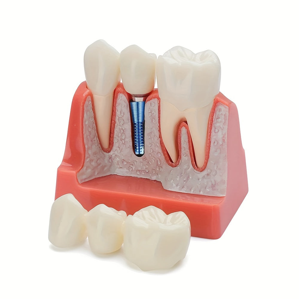 Removable Dental Implant Model with 4 Crown Bridges PVC Material for Education