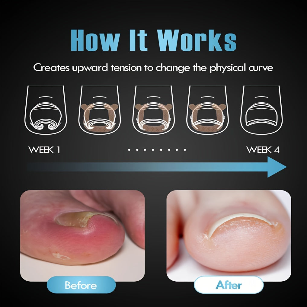 U-Shaped Nail Pads Breathable Fabric Toe Protectors Toe Nail Straightening Strips